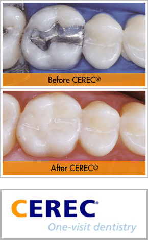 before and after CEREC