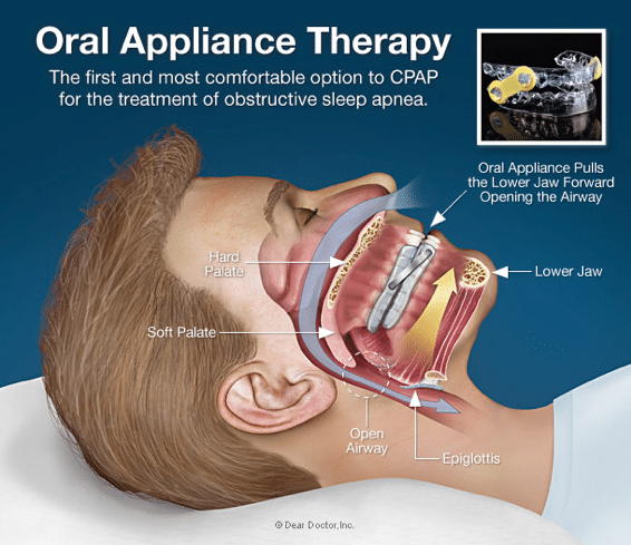 Sleep apnea device