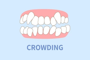 tooth crowding