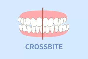 crossbites