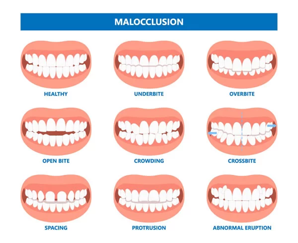 types of malocclusion