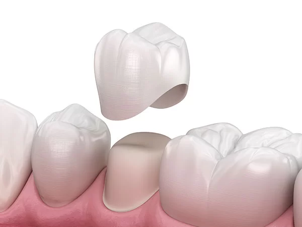 dental crowns; a dental crown